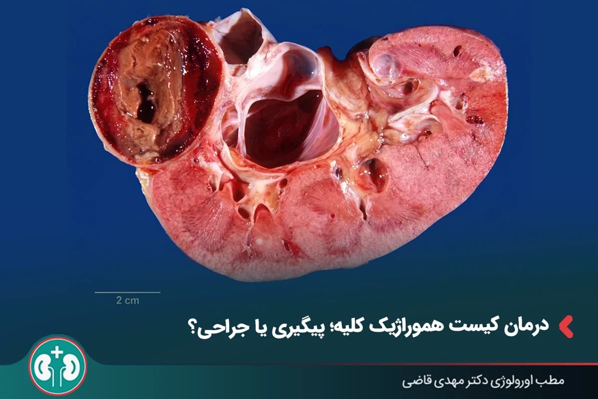 درمان کیست هموراژیک کلیه؛ چه زمانی پیگیری یا جراحی لازم است؟