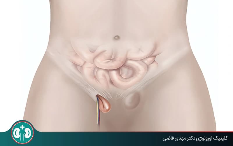 Can a Testicular Hernia Cause Infertility? Scientific Review and Prevention