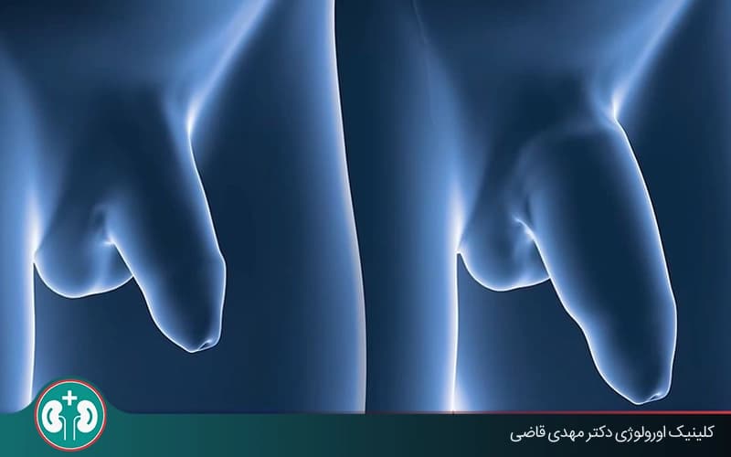 عمل پنوپلاستی برای افزایش طول و قطر آلت؛ بررسی مزایا، عوارض و مراقبت‌ها