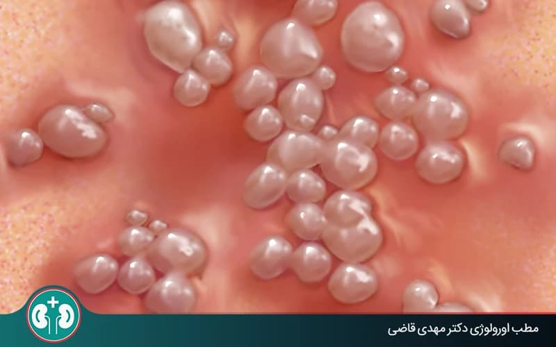 How Often Does Genital Herpes Recur?