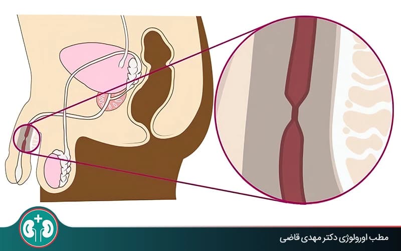 آیا تنگی مجرای ادرار در کودکان خطرناک است؟
