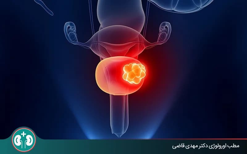 همه چیز درباره جلوگیری از عود سرطان مثانه؛ پیشگیری و مراقبت‌های پزشکی