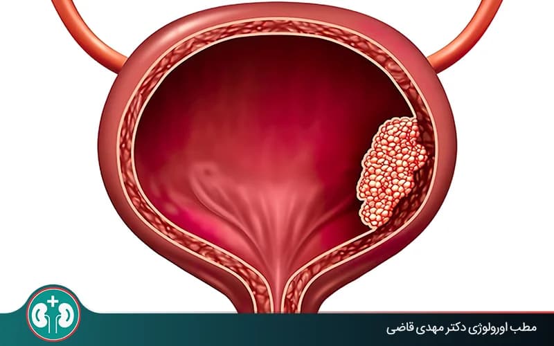 آیا سرطان مثانه درمان قطعی دارد؟ بررسی شانس بهبودی