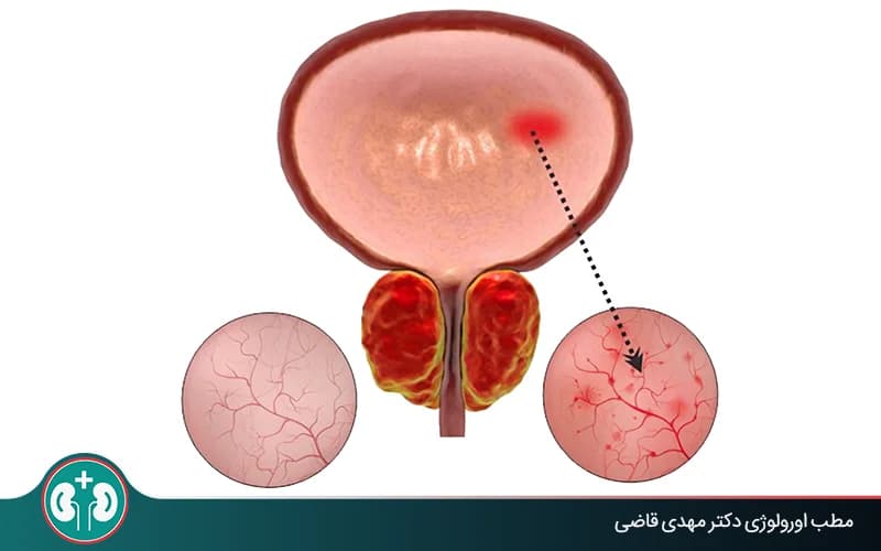 What Is Hemorrhagic Cystitis and How Is It Treated?