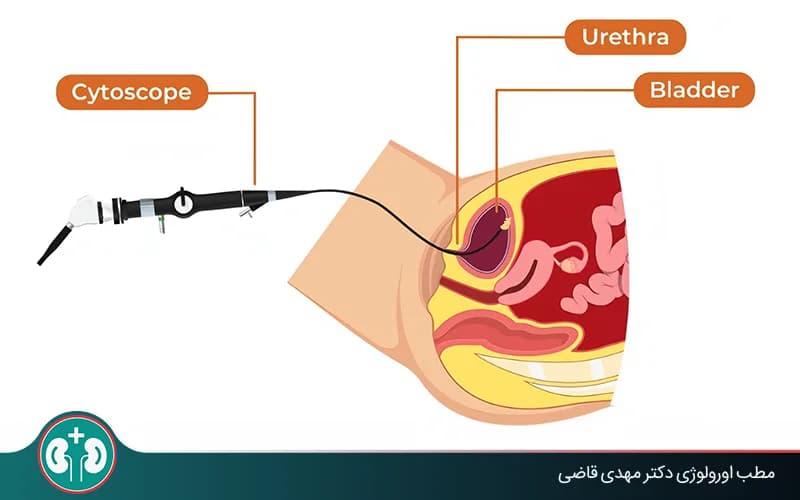 تشخیص سرطان مثانه با سونوگرافی بهتر است یا سیستوسکوپی؟