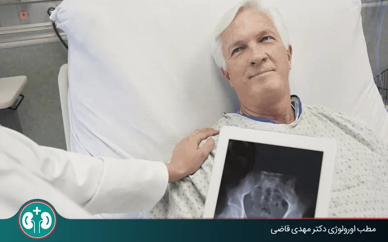 How Long Do Patients With Bladder Cancer Live? Personal and Medical Factors
