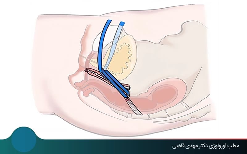Bladder Prolapse Surgery: Laparoscopic, Vaginal, and Open Repair