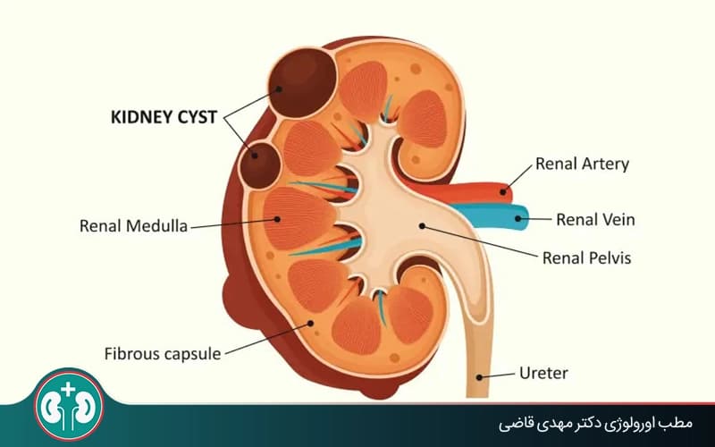 کیست کلیه کورتیکال چیست؟ علائم، تشخیص و درمان
