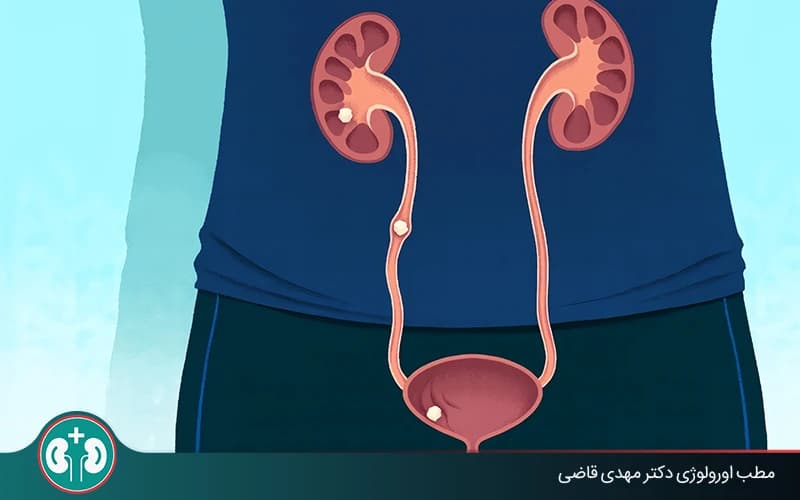 علائم دفع سنگ کلیه چیست و چه زمانی باید به پزشک مراجعه کنیم؟