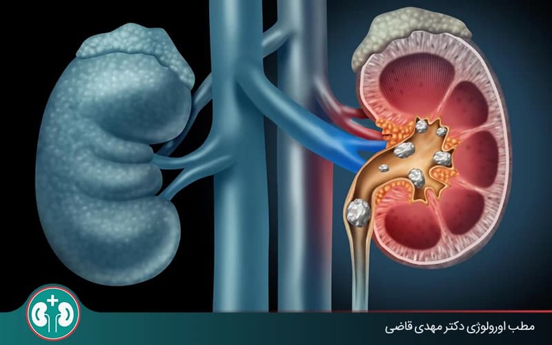 عوارض سنگ کلیه چیست و آیا سنگ کلیه خطرناک است؟
