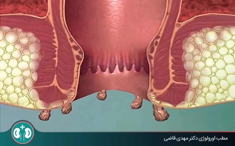 عوارض زگیل تناسلی مقعدی چیست؟ علائم هشدار + درمان