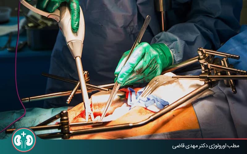 استئصال المثانة في سرطان المثانة: الطرق والفعالية والمضاعفات