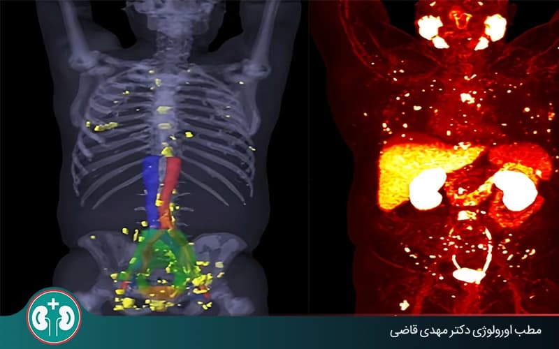 ماذا يحدث إذا انتشر سرطان البروستاتا إلى العظام؟