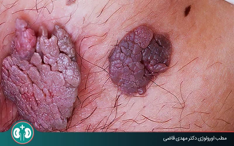 علائم زگیل تناسلی کم خطر چیست؟ | روش تشخیص و درمان