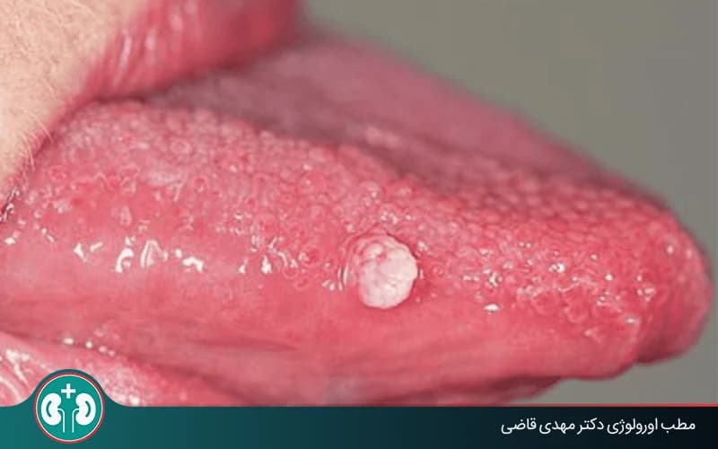 علائم زگیل تناسلی در دهان و روش‌های تشخیص و درمان