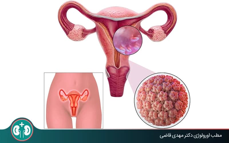 علائم زگیل تناسلی بدخیم + روش‌های تشخیص و درمان