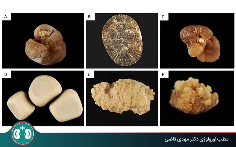أنواع حصوات الكلى حسب اللون والتركيب والشكل والحجم