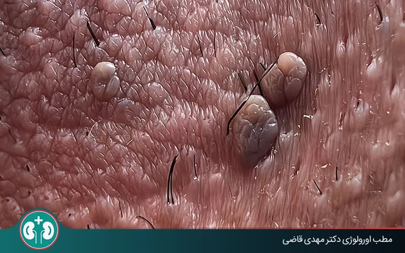 علائم زگیل تناسلی در مردان: نشانه‌ها و تشخیص