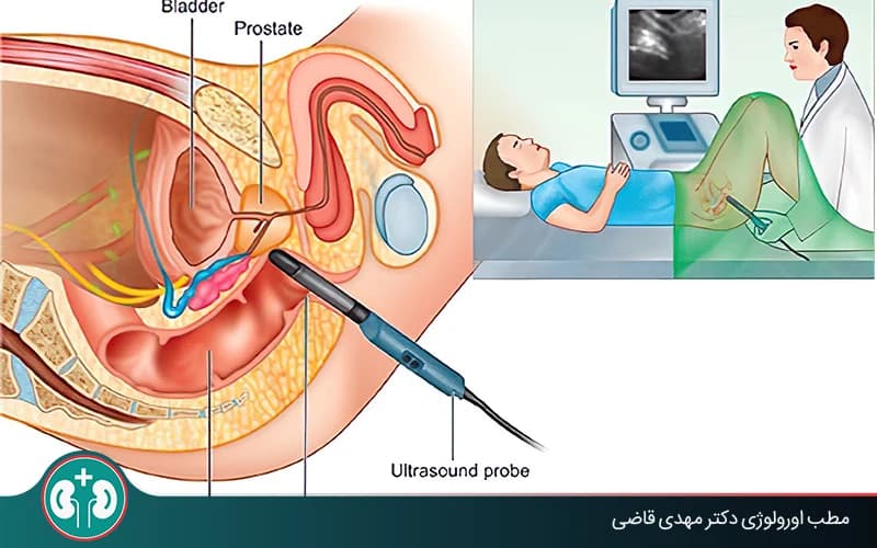 سونوگرافی ترانس‌رکتال پروستات چیست و چرا انجام می‌شود؟