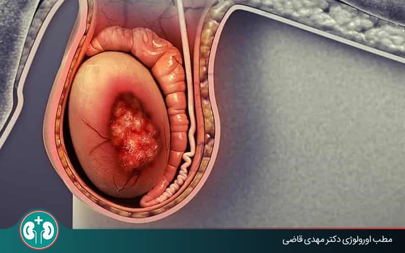هل كل كتلة في الخصية علامة على السرطان؟