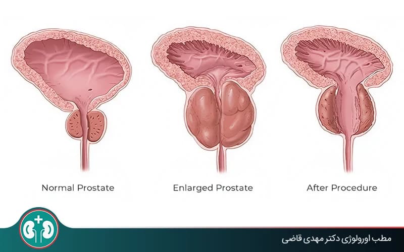 متى يحتاج تضخم البروستاتا إلى عملية؟