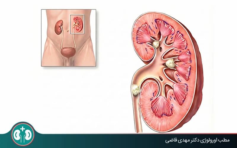 هل يمكن أن تسبب حصوات الكلى الفشل الكلوي؟