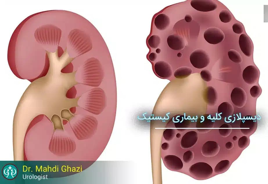 بیماری‌های کیستیک و دیسپلازی کلیه: علائم، تشخیص و درمان‌ های موثر