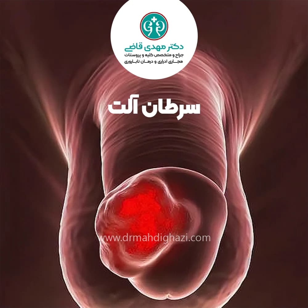 دکتر قاضی -سرطان آلت تناسلی درمان و علائم