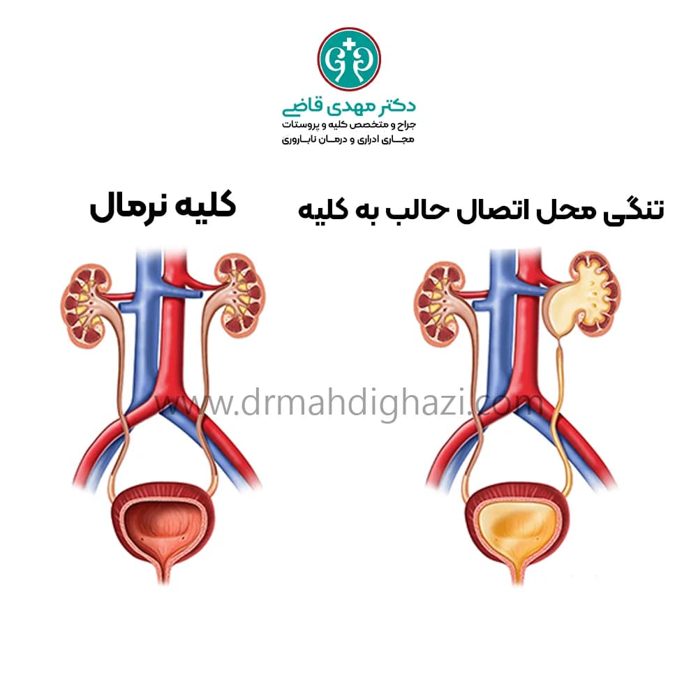 دکتر قاضی- تنگی مجرای ادرار