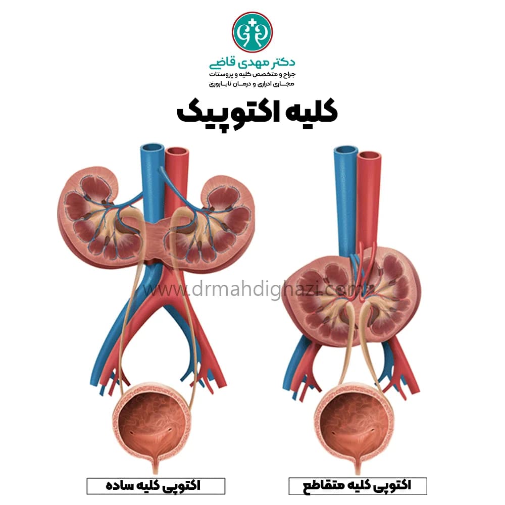 الدكتور مهدي قاضي-کلیه اکتوپیک