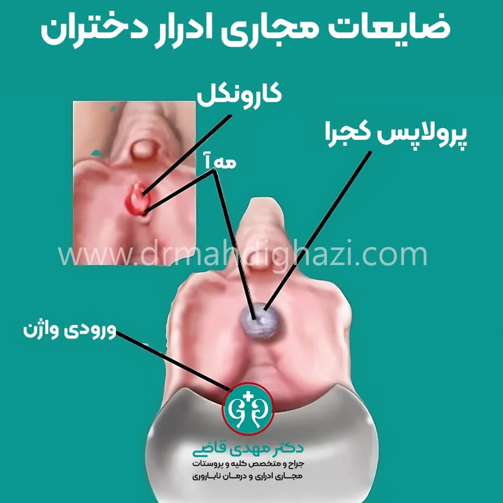 الدكتور مهدي قاضي - • پیشگیری از عوارض توده‌های خوش خیم مجرای ادرار در دختران