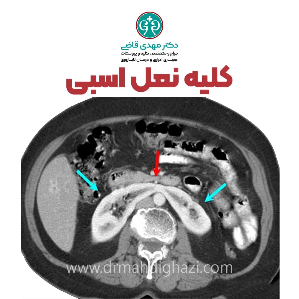 الدكتور مهدي قاضي-کلیه نعل اسبی