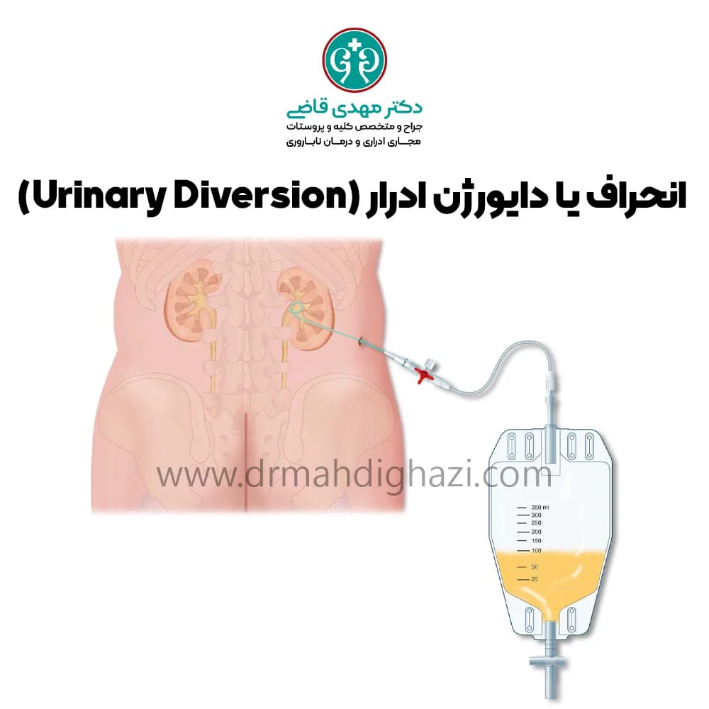 قاضی-دایورژن ادراری انحراف ادرار