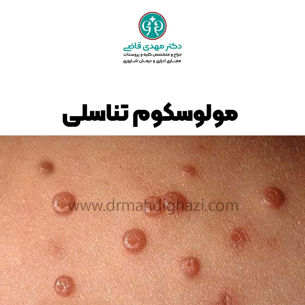 الدكتور مهدي قاضي- مولوسکوم تناسلی