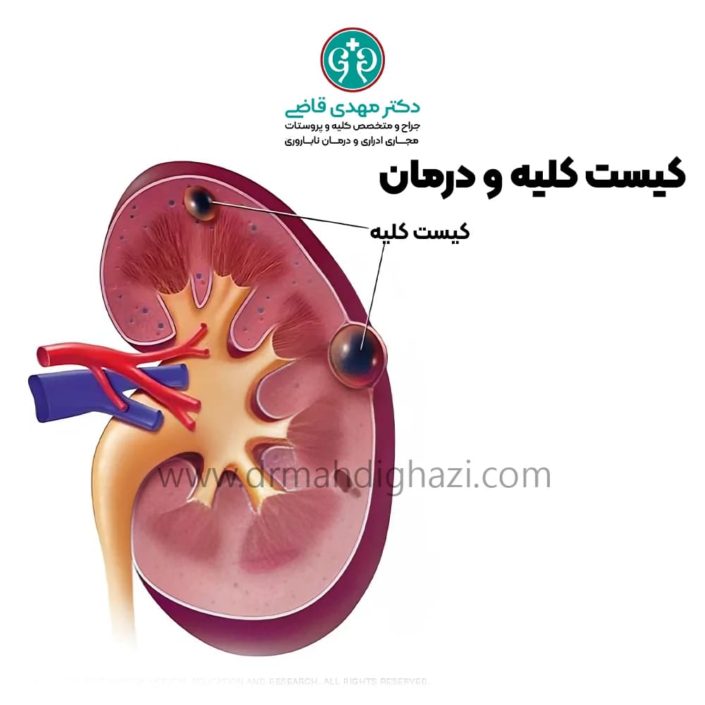 دکتر قاضی-کیست کلیه: علل، علائم، تشخیص و روش‌های درمان