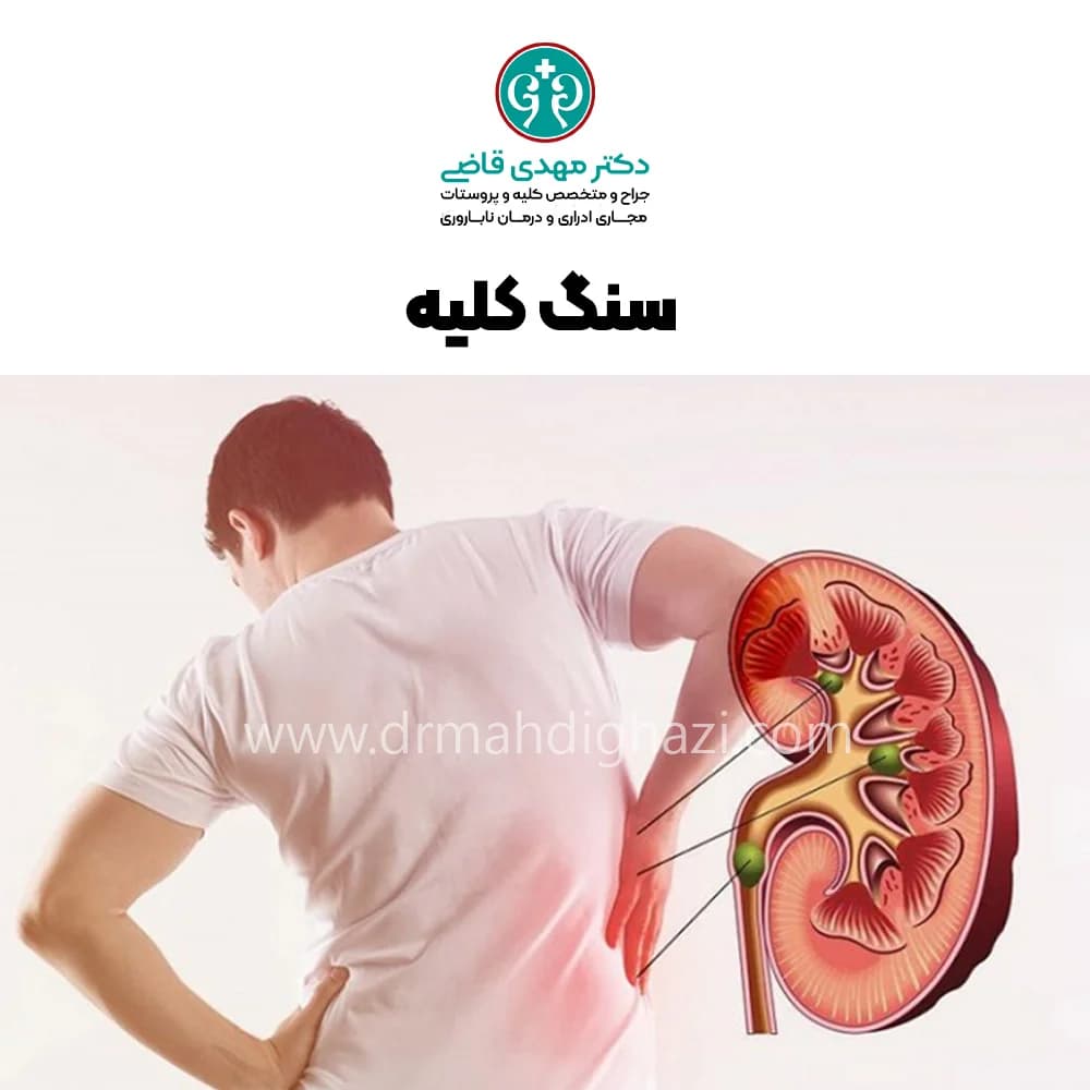 دکتر قاضی- علل رایج تشکیل سنگ کلیه در مردان و زنان