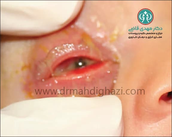 دکتر قاضی-سوزاک: علائم، تشخیص، درمان و پیشگیری از این بیماری مقاربتی شایع