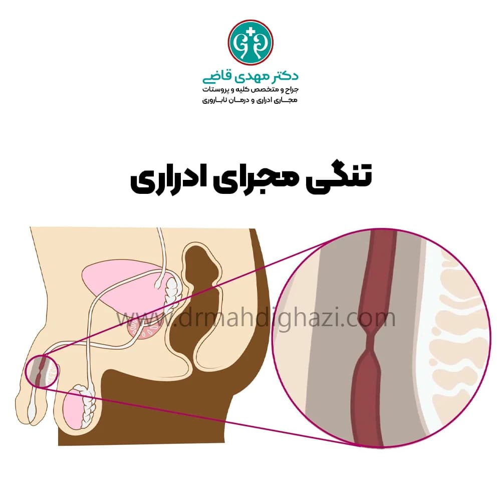 دکتر قاضی-تنگی مجرای ادرار علائم درمان