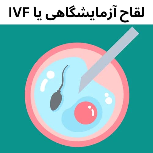 لقاح آزمایشگاهی یا آی وی اف (IVF) چیست ؟