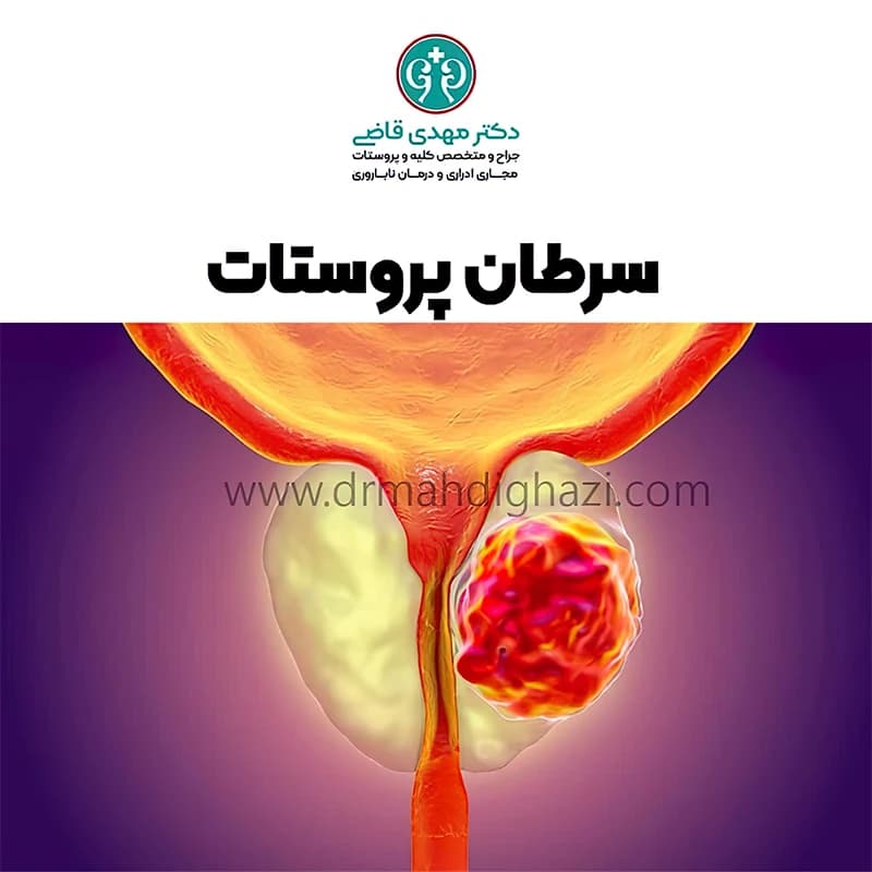 سرطان پروستات: علل، علائم، تشخیص و روش‌های درمان