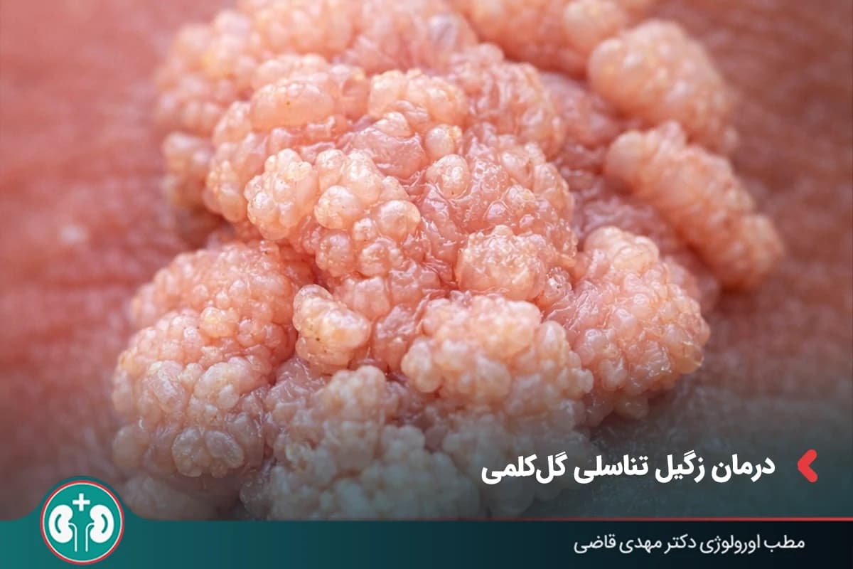 درمان زگیل تناسلی گلکلمی و خوشهای | لیزر، فریز، جراحی