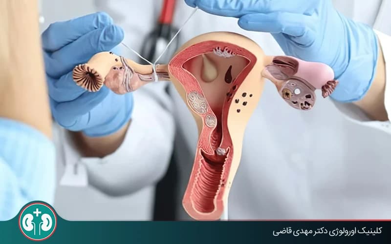 جراحی توبکتومی زنان چیست؟ + مزایا و معایب و عوارض احتمالی
