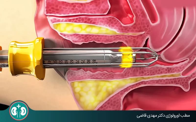 لمن يناسب علاج هبوط المثانة بالليزر؟
