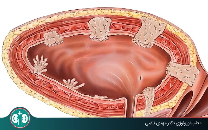 ما سليلة المثانة وكيف تُعالج؟