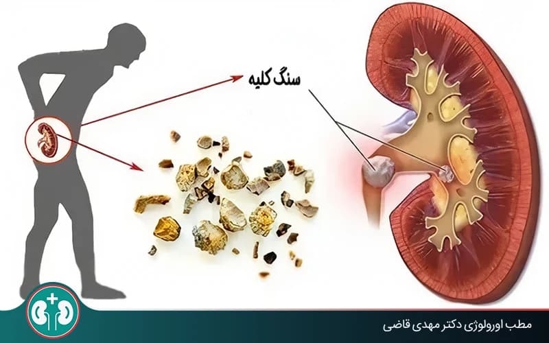 ماذا يحدث إذا وصلت حصى الكلى إلى المسالك البولية؟