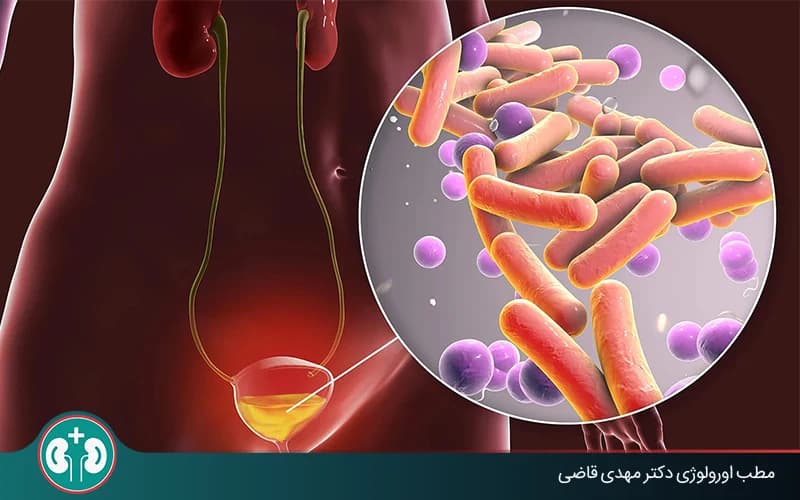 تصویر شماتیک دستگاه ادراری که التهاب مثانه و باکتریهای عامل عفونت مثانه را نشان میدهد.