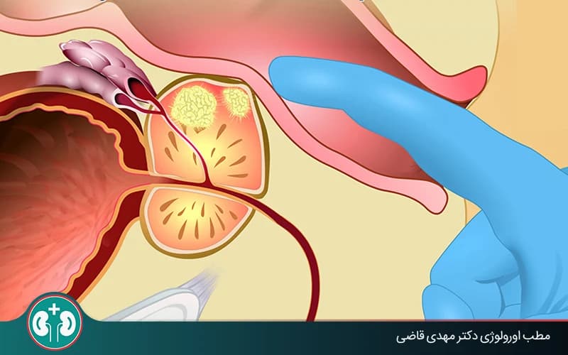 كيف يُجرى فحص البروستاتا عبر المستقيم (DRE)؟ الخطوات والنصائح