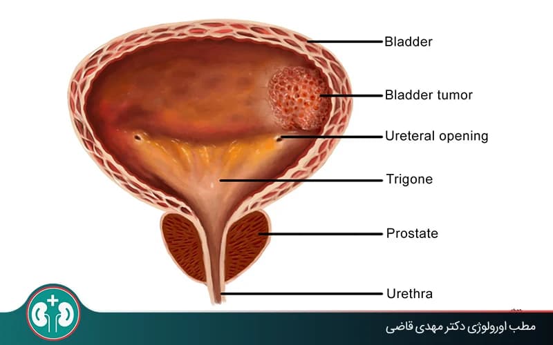 ما الورم الحميد في المثانة؟ الفرق بينه وبين سرطان المثانة