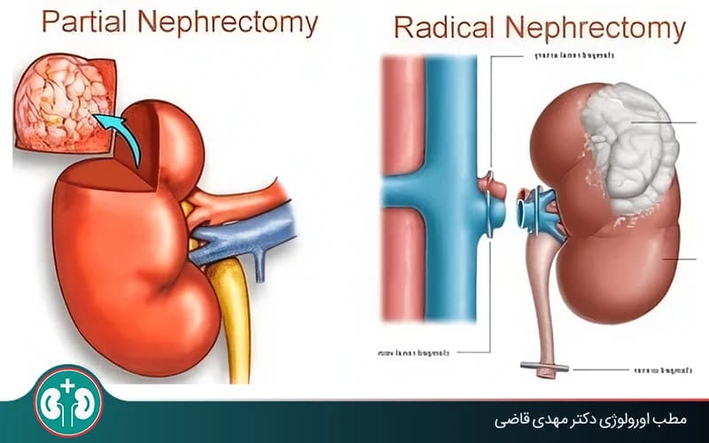 ما هو استئصال الكلية؟ جراحة إزالة الكلية الجزئية والجذرية