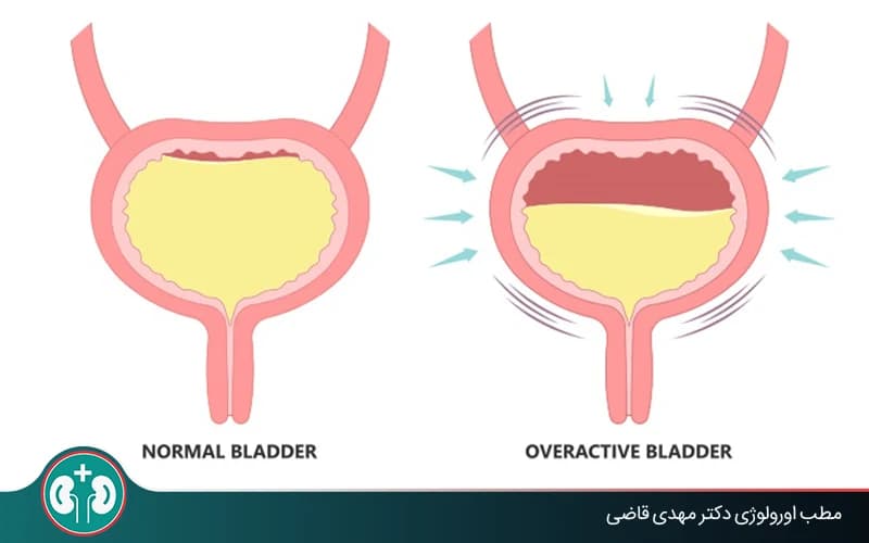 العلاجات العشبية لفرط نشاط المثانة: مراجعة علمية وأدوية فعالة